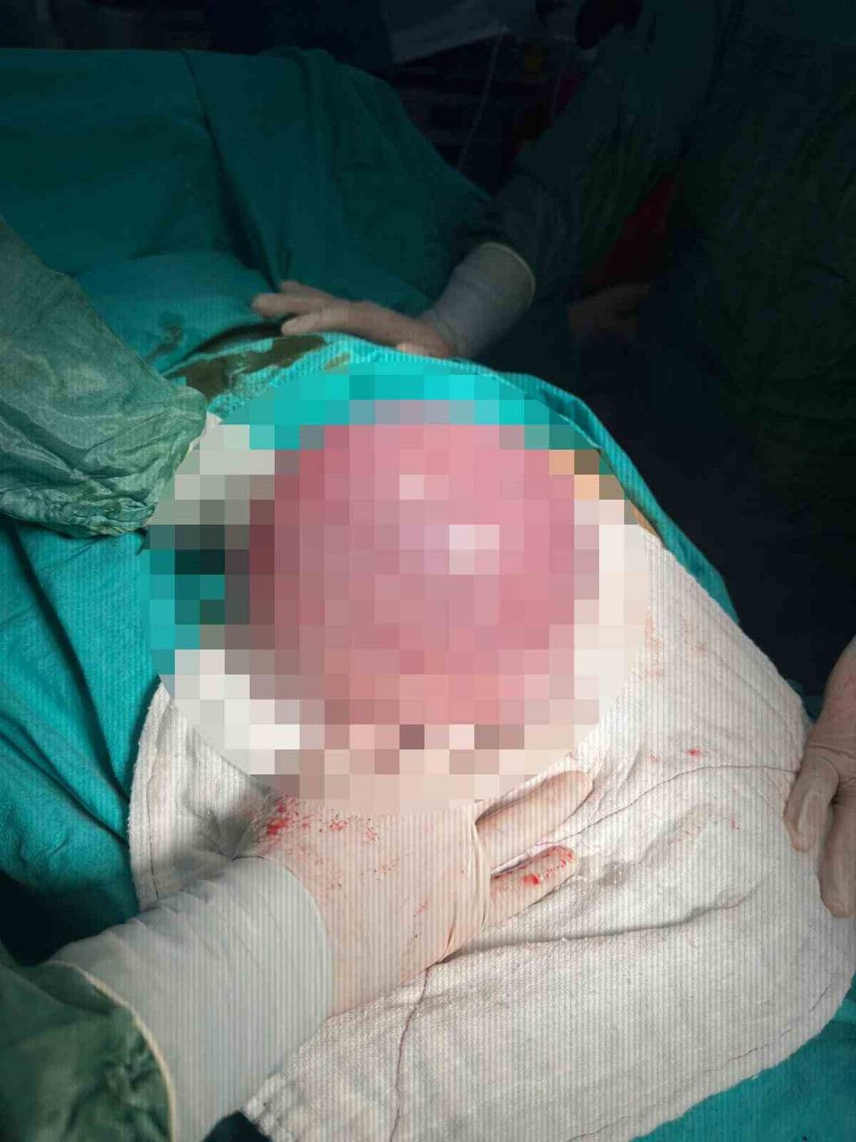 Karın Bölgesinde Devasa Tümör Çıkartıldı