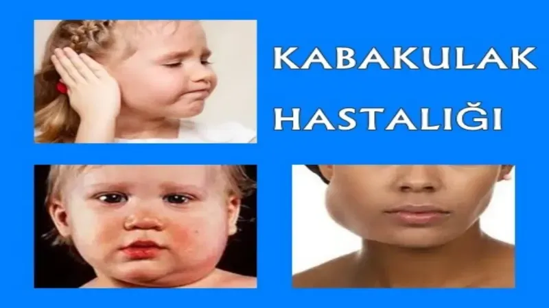 Çocuklardan yetişkinlere kabakulak hastalığından Nasıl Korunabiliriz?