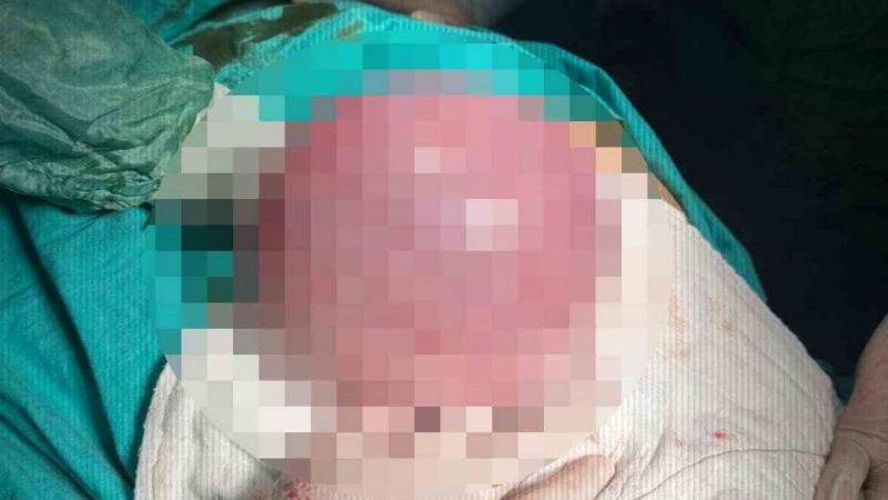 Karın Bölgesinde Devasa Tümör Çıkartıldı