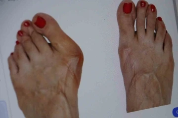 Topuklu ve Sivri Burun Ayakkabılar: Ayak Sağlığınızı Tehdit Ediyor mu?