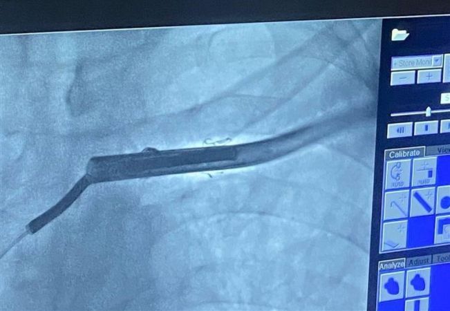 ilk defa kırık olan kalp pili kablosu operasyonla çıkarıldı